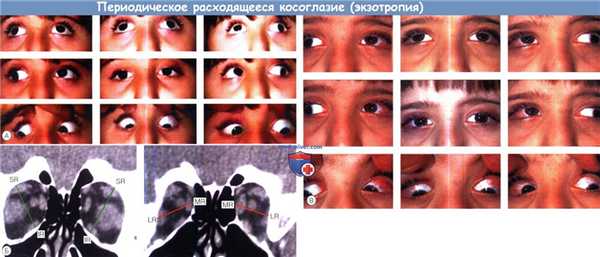 Периодическое расходящееся косоглазие