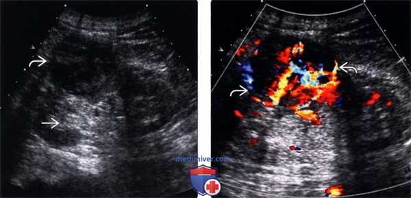 УЗИ при почечноклеточном раке почки