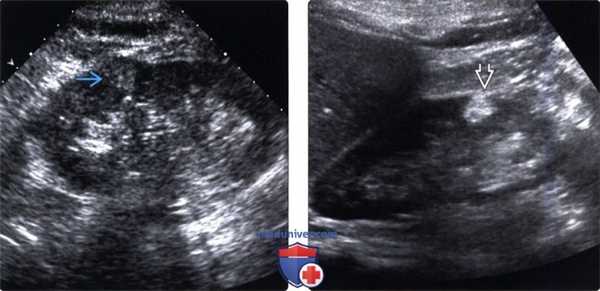 УЗИ при почечноклеточном раке почки