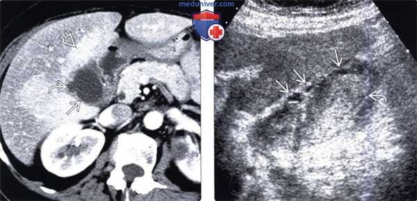 КТ, МРТ, УЗИ признаки ксантогранулематозного холецистита
