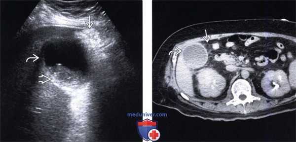 УЗИ, КТ при остром калькулезном холецистите