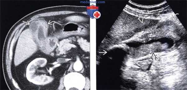 КТ, МРТ, УЗИ признаки ксантогранулематозного холецистита