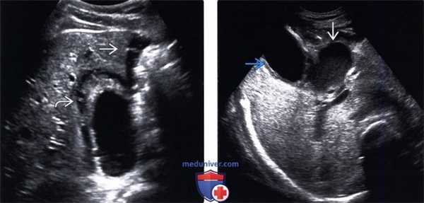 УЗИ, КТ при остром калькулезном холецистите