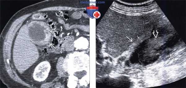 КТ, МРТ, УЗИ признаки ксантогранулематозного холецистита