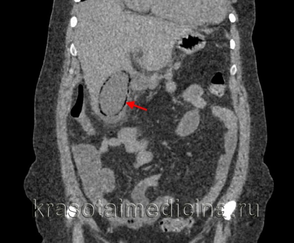Холецистит