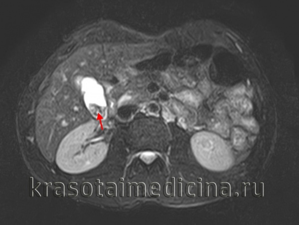 Холецистит