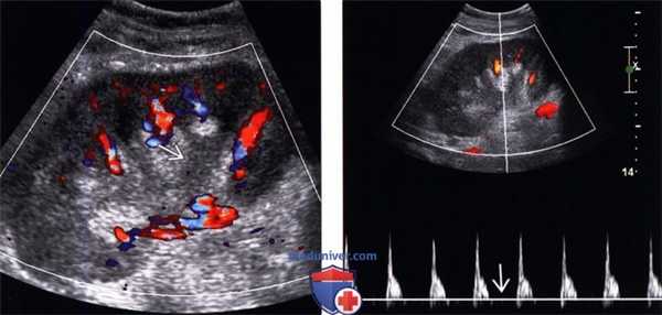 УЗИ при отторжении трансплантата почки