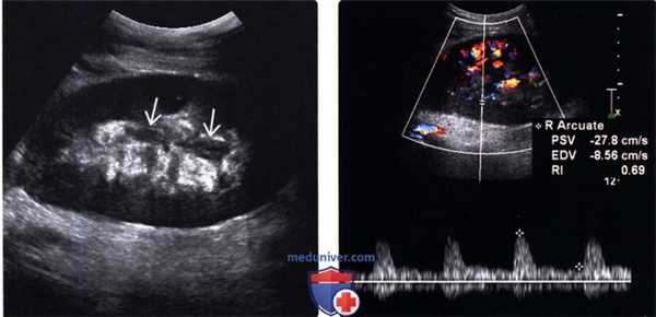 УЗИ при отторжении трансплантата почки
