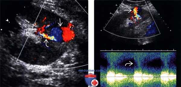 УЗИ при псевдоаневризме трансплантата почки