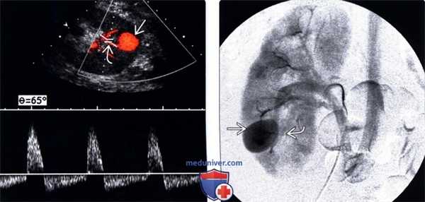 УЗИ при псевдоаневризме трансплантата почки