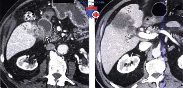 КТ, МРТ, УЗИ признаки рака желчного пузыря
