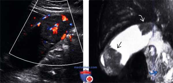 УЗИ при раке желчного пузыря