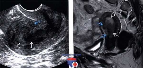 Методы обследования рака эндометрия