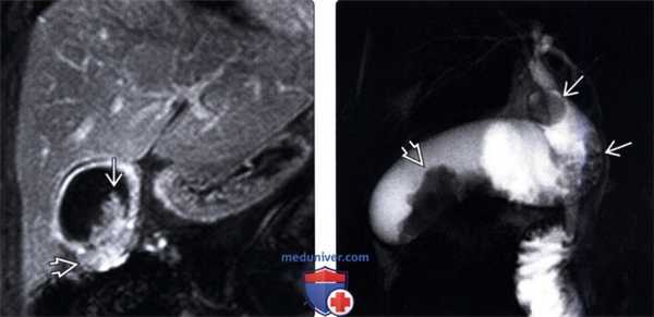 МРТ при раке желчного пузыря