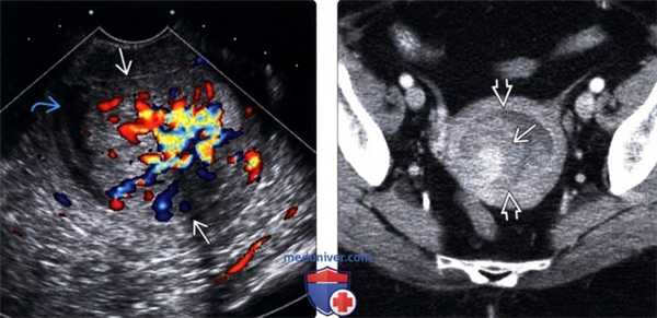 Методы обследования рака эндометрия