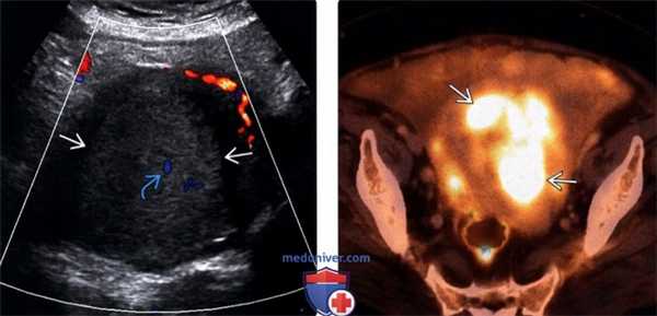 Методы обследования рака эндометрия