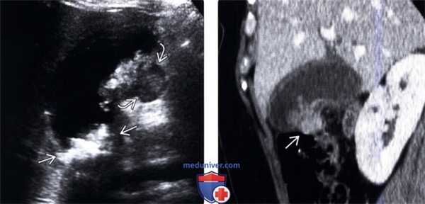 УЗИ, КТ при раке желчного пузыря