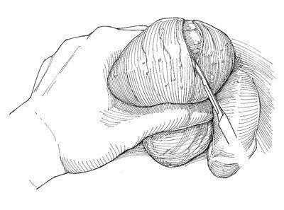 Сперматоцелэктомия