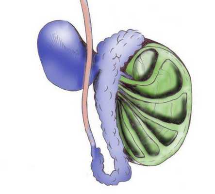 Сперматоцеле