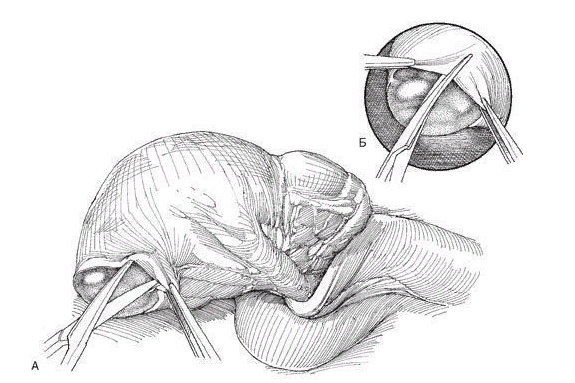 Через разрез выпускают кисту вместе с яичком (А), накладывают зажимы (Б)
