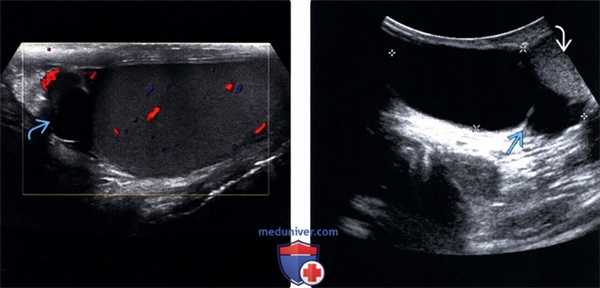 УЗИ при сперматоцеле и кисте придатка яичка