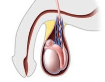 Киста придатка