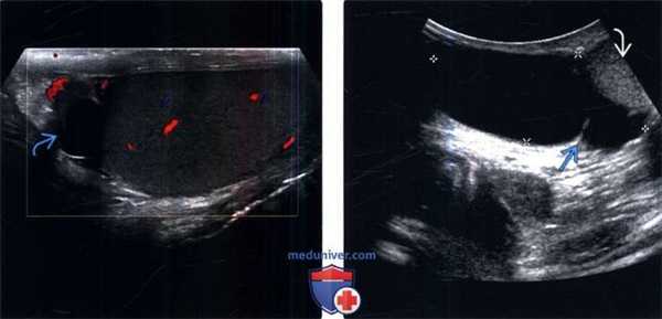УЗИ при сперматоцеле (кисте придатка)
