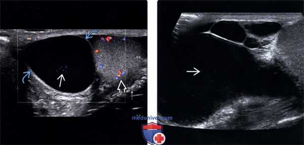 УЗИ при сперматоцеле и кисте придатка яичка
