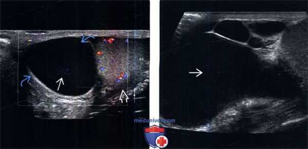 УЗИ при сперматоцеле (кисте придатка)