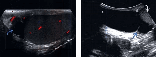 Слева маленькая, клинически незначимая киста на головке придатка, справа – крупная многокамерная