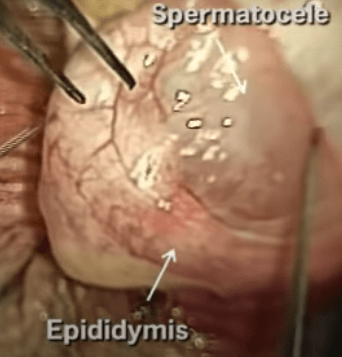 Стоп-кадр операции по удалению сперматоцеле