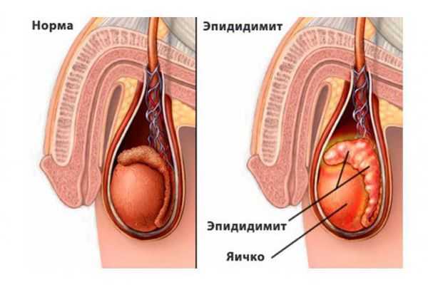 Воспаление придатка яичка