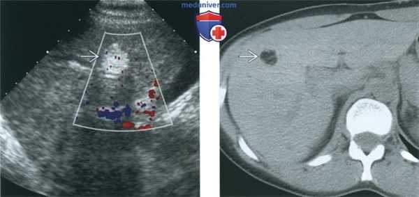 КТ, МРТ, УЗИ при незрелой тератоме яичника