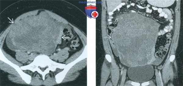 КТ, МРТ, УЗИ при незрелой тератоме яичника