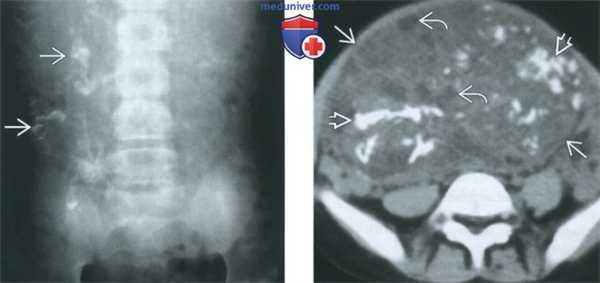 КТ, МРТ, УЗИ при незрелой тератоме яичника