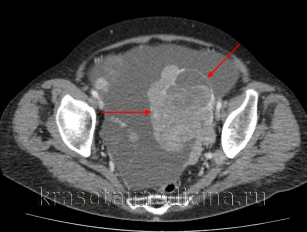 Тератома яичника