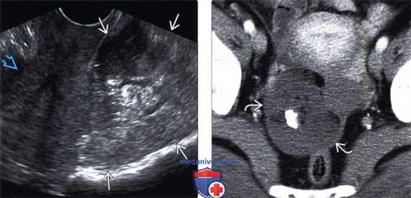 Методы обследования тератомы яичника
