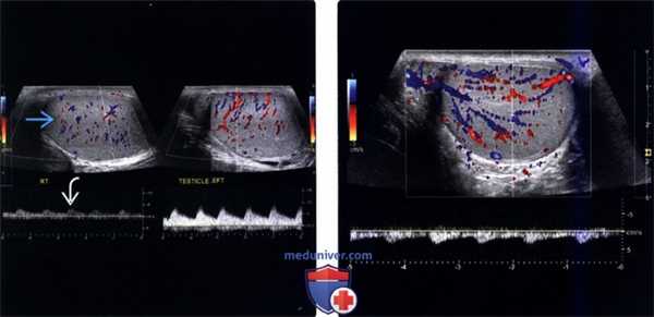 Методы обследования перекрута и инфаркта яичка