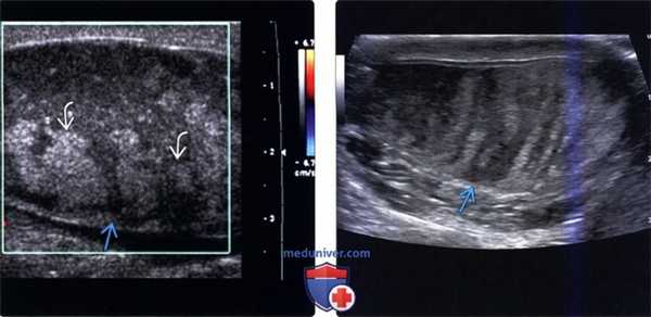 Методы обследования перекрута и инфаркта яичка