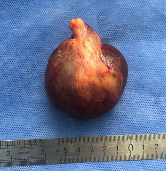 Инфаркт яичка. Макроперпарат. (фото Давыдов Д.С.)