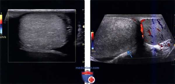 Методы обследования перекрута и инфаркта яичка