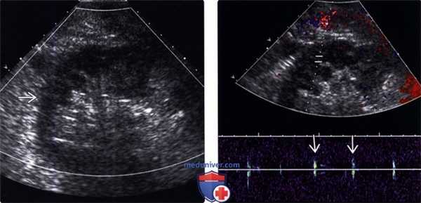 УЗИ при тромбозе почечной артерии трансплантата почки