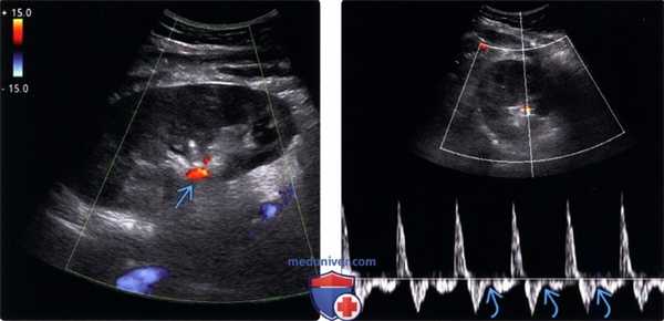 Методы обследования тромбоза почечной вены