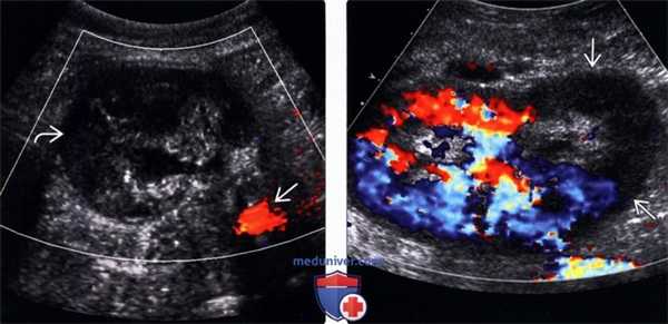 УЗИ при тромбозе почечной артерии трансплантата почки