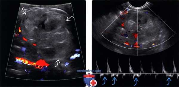 Методы обследования тромбоза почечной вены