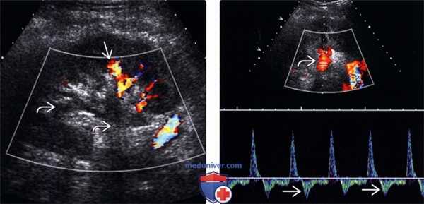 УЗИ при тромбозе почечной вены трансплантата почки