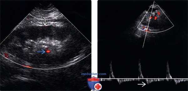 УЗИ при тромбозе почечной вены трансплантата почки