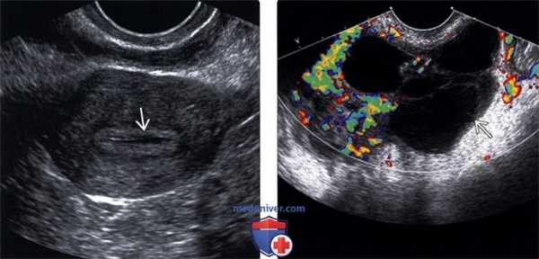 Методы обследования тубоовариального абсцесса