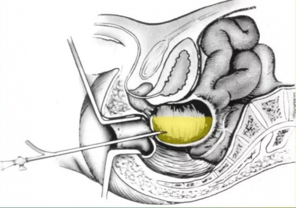 Трансректальная пункция абсцесса