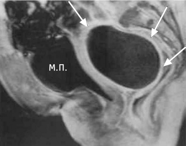 МРТ малого таза. Стрелками показано скопление жидкости позади мочевого пузыря (МП)